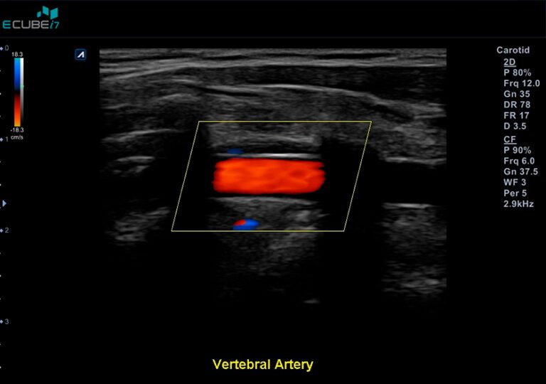 Excellent-color-Doppler-sensitivity-in-Vertebral-artery